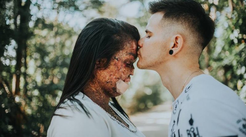 Woman With Rare Incurable Skin Disease Believes God Sent Her True Love